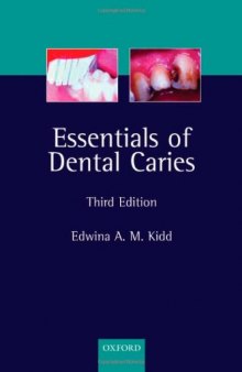 Essentials of Dental Caries: The Disease and Its Management