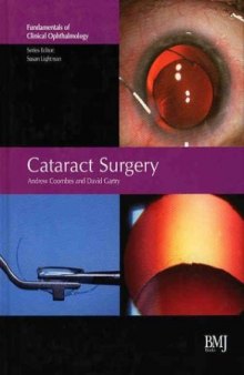 Cataract Surgery: FCO Series