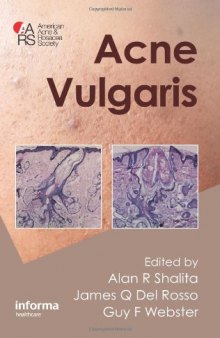 Acne Vulgaris  