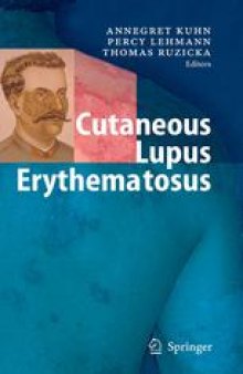 Cutaneous Lupus Erythematosus