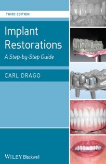 Implant restorations : a step by step guide