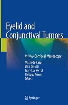 Eyelid and Conjunctival Tumors: In Vivo Confocal Microscopy