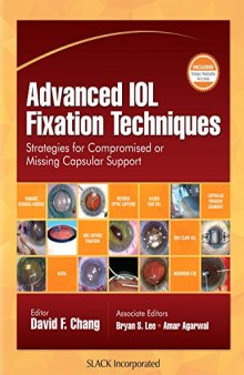 Advanced IOL Fixation Techniques: Strategies for Compromised or Missing Capsular Support