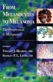 From melanocytes to melanoma: the progression to malignancy
