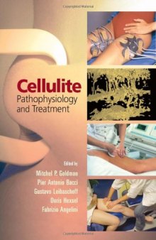 Cellulite Pathophysiology and Treatment