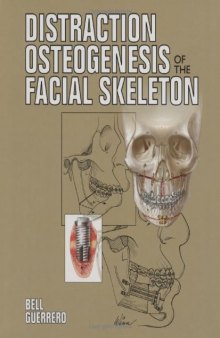 Distraction Osteogenesis of the Facial Skeleton