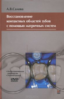 Восстановление контактных областей зубов с помощью матричных систем