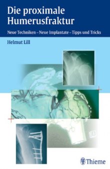 Die proximale Humerusfraktur: Neue Techniken, Neue Implantate - Tipps und Tricks