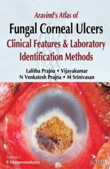 Aravind's atlas of fungal corneal ulcers: clinical features and laboratory identification methods