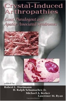 Crystal-Induced Arthropathies: Gout, Pseudogout and Apatite-Associated Syndromes