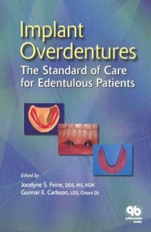 Implant Overdentures: The Standard of Care for Edentulous Patients