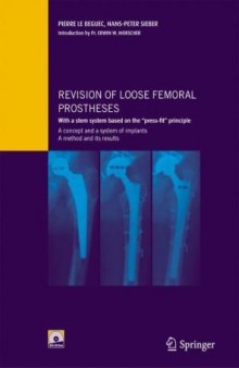 Revision of loose femoral prostheses with a stem system based on the "press-fit" principle: A concept and its system of implants, a method and its results