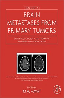 Brain Metastases from Primary Tumors, Volume 3. Epidemiology, Biology, and Therapy of Melanoma and Other Cancers