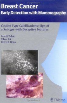 Casting Type Calcifications Sign of a Subtype with Deceptive Features