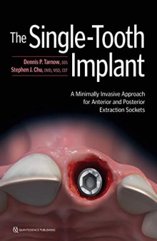 Single-Tooth Implant