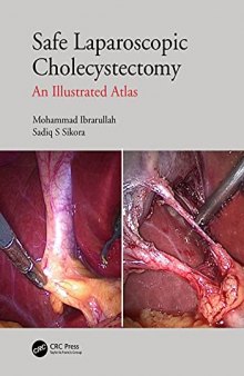 Safe Laparoscopic Cholecystectomy: An Illustrated Atlas