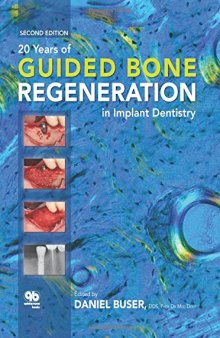 20 Years of Guided Bone Regeneration in Implant Dentistry