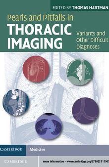 Pearls and Pitfalls in Thoracic Imaging: Variants and Other Difficult Diagnoses