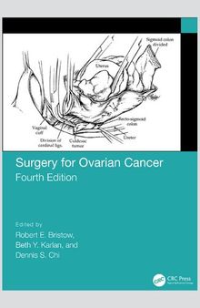 Surgery for Ovarian Cancer