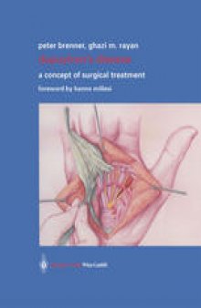 Dupuytren’s Disease: A Concept of Surgical Treatment