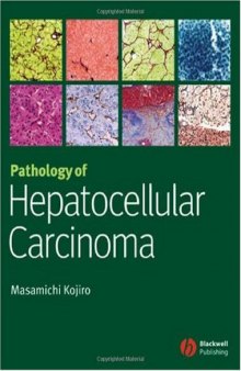 Pathology of Hepatocellular Carcinoma