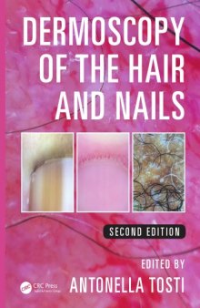 Dermoscopy of the hair and nails