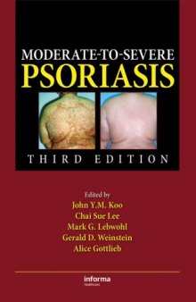 Moderate-to-Severe Psoriasis, Third Edition