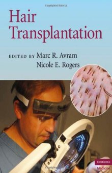 Hair Transplantation (Cambridge Medicine)