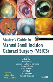Master's Guide to Manual Small Incision Cataract Surgery