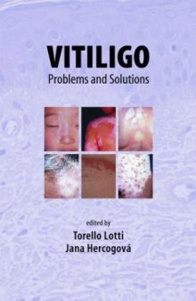 Vitiligo: Problems and Solutions