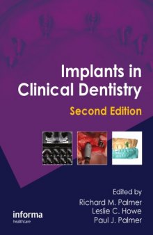 Implants in Clinical Dentistry, Second Edition  