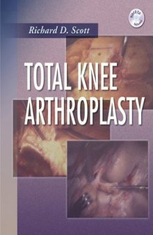 Total Knee Arthroplasty  