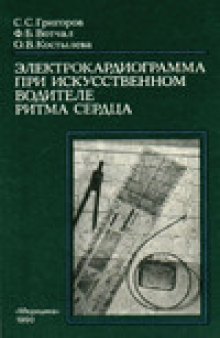 Электрокардиограмма при искусственном водителе ритма сердца