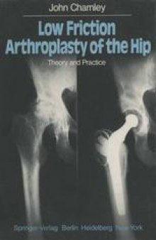 Low Friction Arthroplasty of the Hip: Theory and Practice