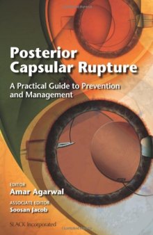 Posterior Capsular Rupture: A Practical Guide to Prevention and Management