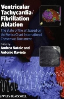 Ventricular Tachycardia   Fibrillation Ablation: The state of the Art based on the VeniceChart International Consensus Document