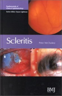 Scleritis