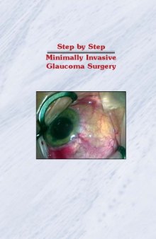 Step by Step Minimally Invasive Glaucoma Surgery  