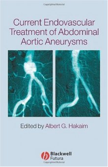 Current Endovascular Treatment of Abdominal Aortic Aneurysms