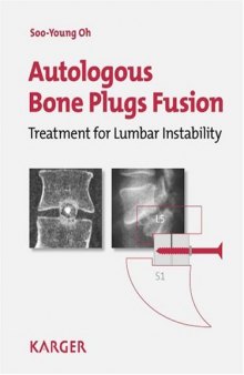 Autologous Bone Plugs Fusion: Treatment for Lumbar Instability: 3E Criteria  Technical Operative Notes  The Functioning of the Oh's Screw