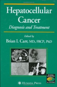 Hepatocellular cancer: diagnosis and treatment