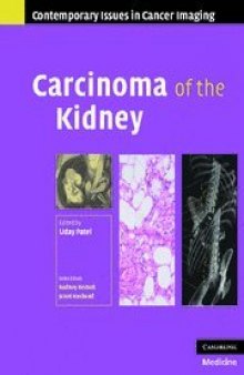 Carcinoma of the Kidney
