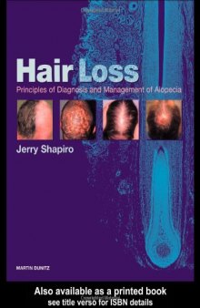 Hair Loss: Principles of Diagnosis and Management of Alopecia