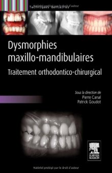 Dysmorphies Maxillo-mandibulaires. Traitement orthodontico-chirurgical