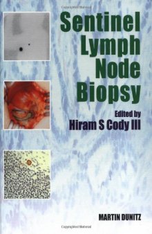 Sentinel lymph node biopsy