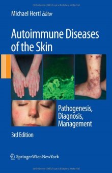 Autoimmune Diseases of the Skin: Pathogenesis, Diagnosis, Management