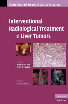Interventional Radiological Treatment of Liver Tumors (Contemporary Issues in Cancer Imaging)