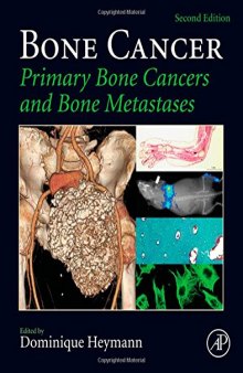 Bone cancer : primary bone cancers and bone metastases