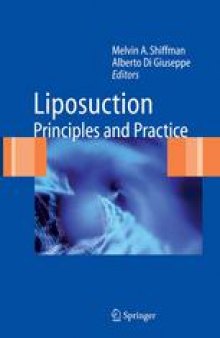 Liposuction: Principles and Practice