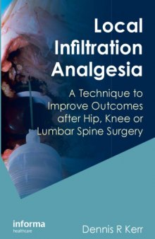 Local Infiltration Analgesia : a Technique to Improve Outcomes after Hip, Knee or Lumbar Spine Surgery